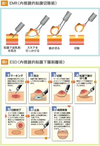 EMR（内視鏡的粘膜切除術） / ESD（内視鏡的粘膜下層剥離術）